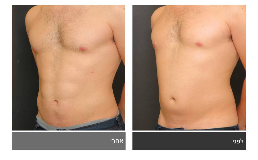 ניתוח קוביות בבטן - תמונות לפני ואחרי 7