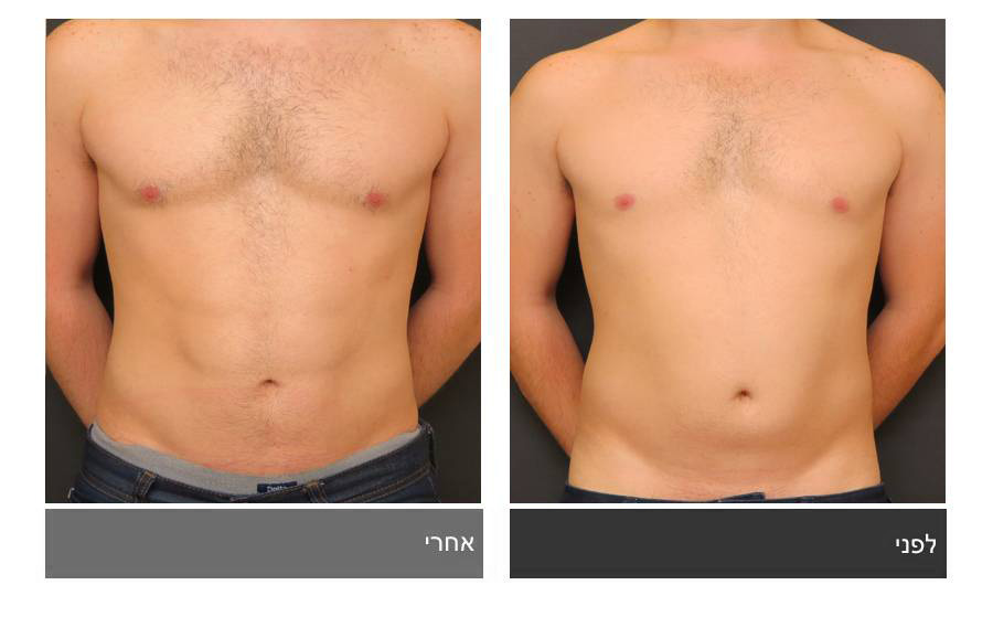 ניתוח קוביות בבטן - תמונות לפני ואחרי 8
