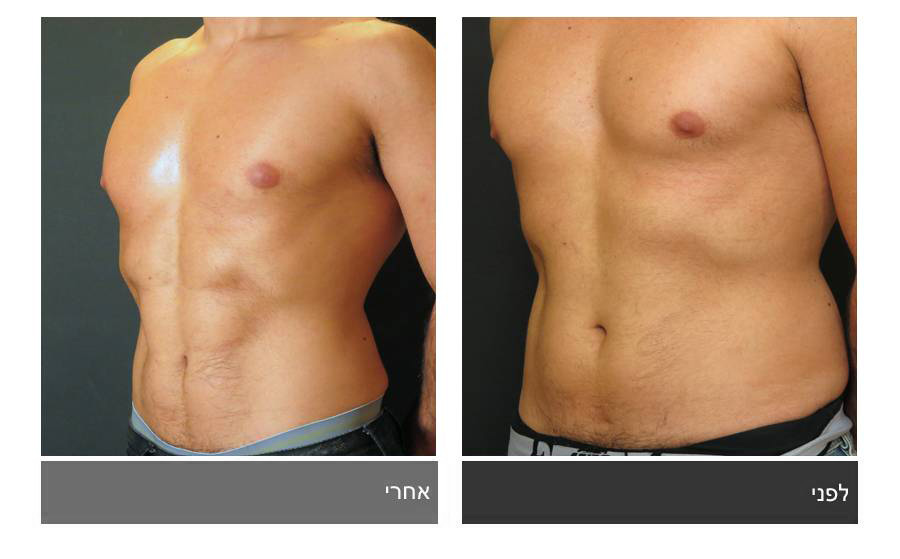 ניתוח קוביות בבטן - תמונות לפני ואחרי 10
