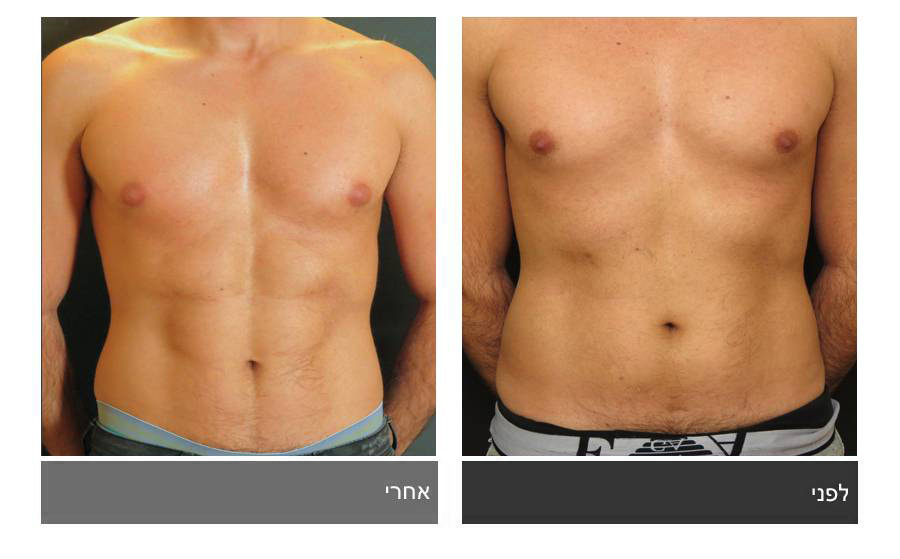 ניתוח קוביות בבטן - תמונות לפני ואחרי 11