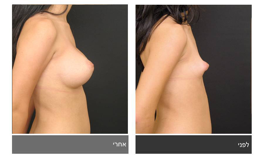ניתוח חזה טובולרי - תמונות לפני ואחרי 13