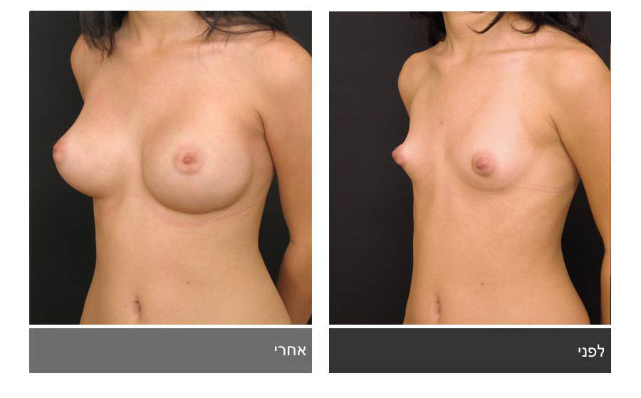 ניתוח חזה טובולרי - תמונות לפני ואחרי 13