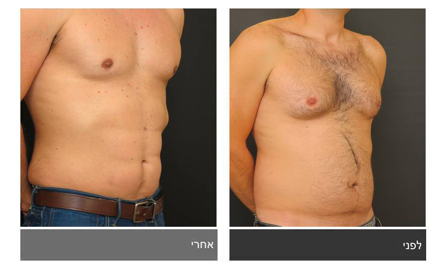 ניתוח קוביות בבטן - תמונות לפני ואחרי 12