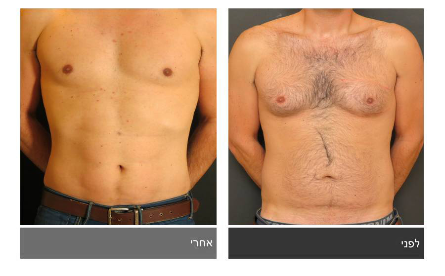 ניתוח קוביות בבטן - תמונות לפני ואחרי 14