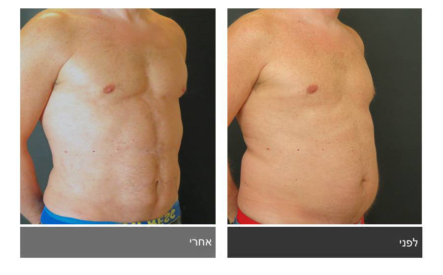 ניתוח קוביות בבטן - תמונות לפני ואחרי 15