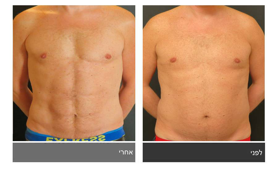 ניתוח קוביות בבטן - תמונות לפני ואחרי 16