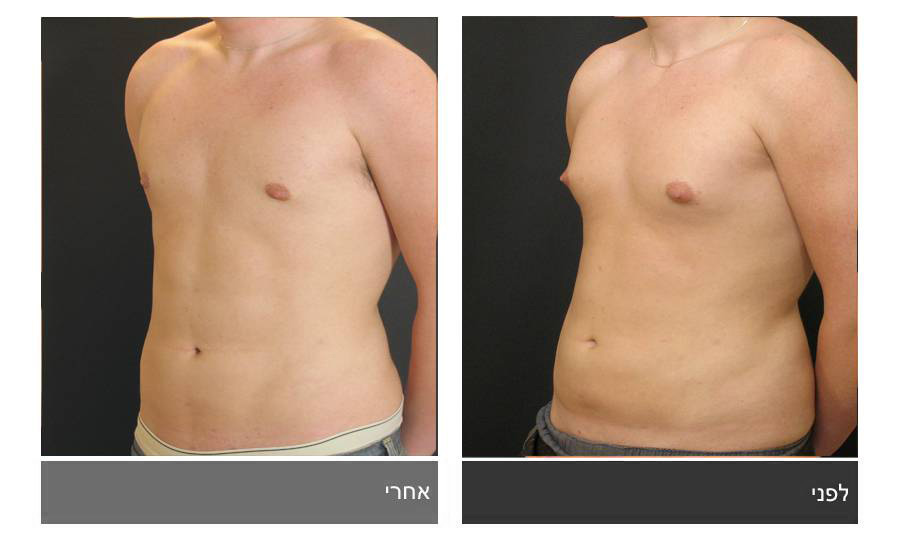 ניתוח קוביות בבטן - תמונות לפני ואחרי 20