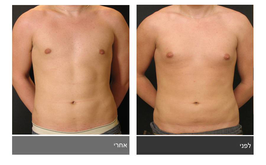ניתוח קוביות בבטן - תמונות לפני ואחרי 21