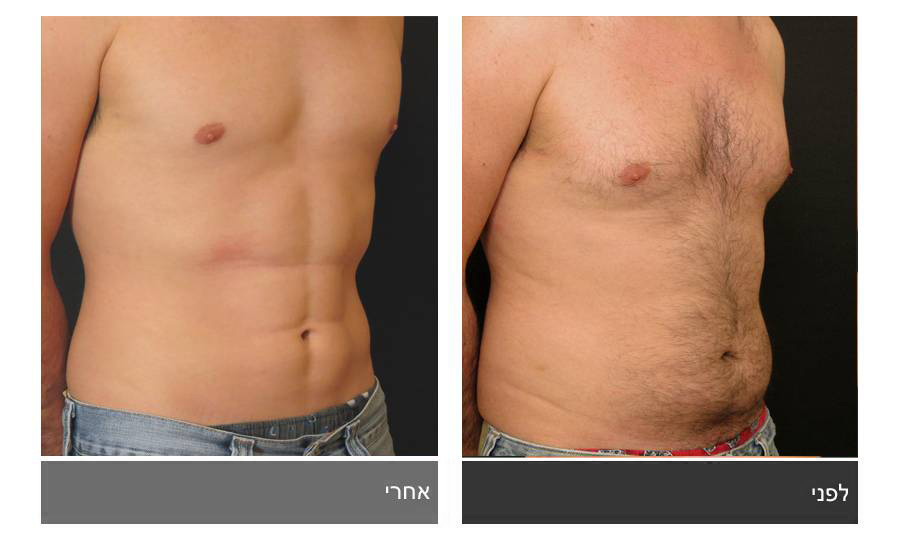 ניתוח קוביות בבטן - תמונות לפני ואחרי 22