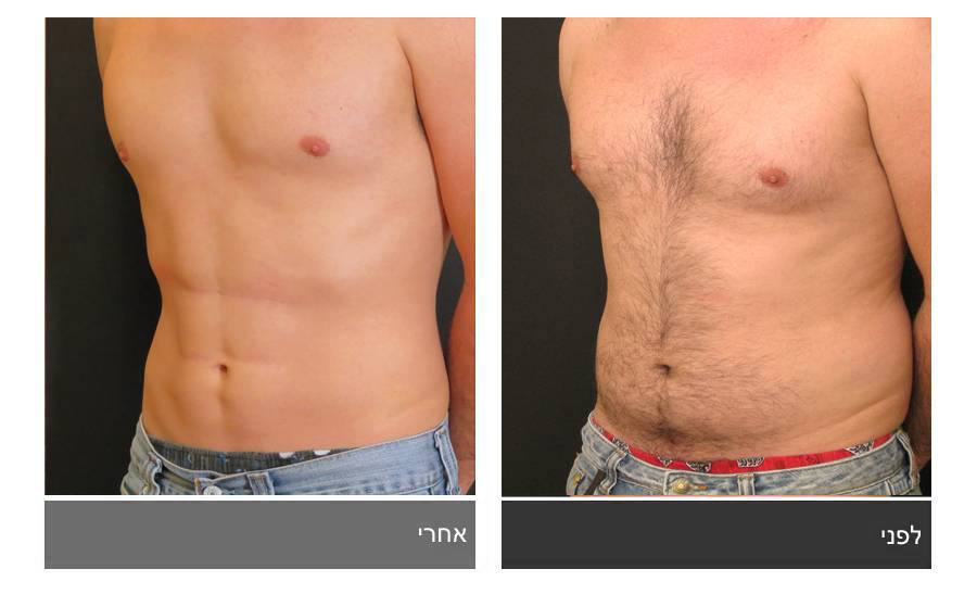 ניתוח קוביות בבטן - תמונות לפני ואחרי 23