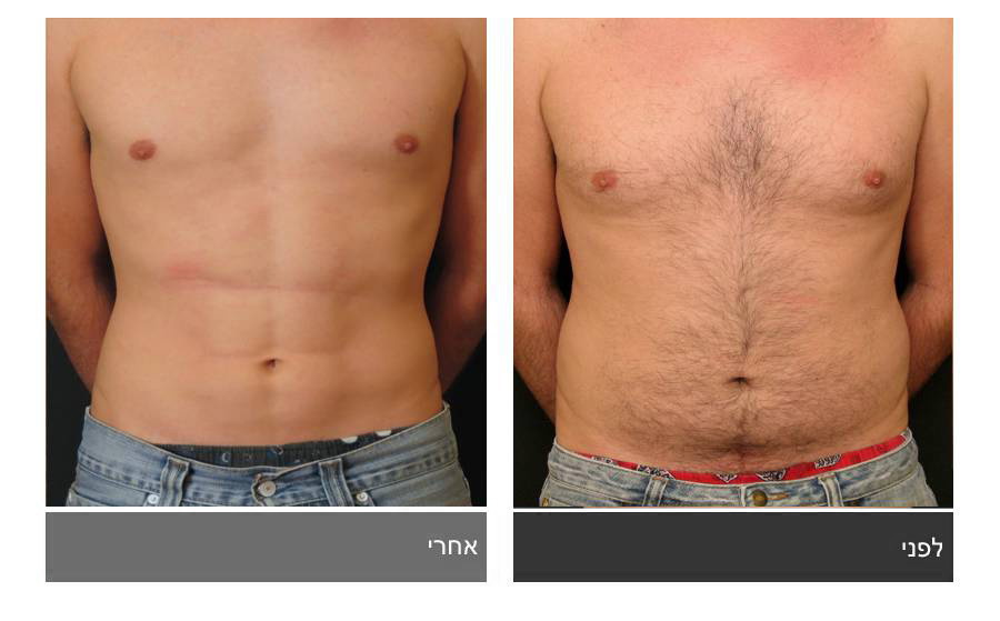 ניתוח קוביות בבטן - תמונות לפני ואחרי 24