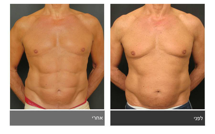 ניתוח קוביות בבטן - תמונות לפני ואחרי 3