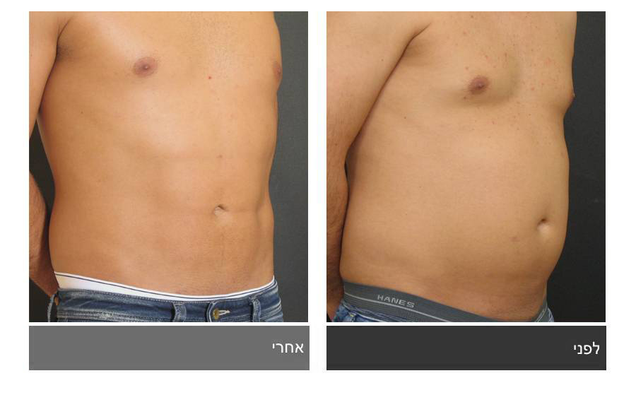 ניתוח קוביות בבטן - תמונות לפני ואחרי 4