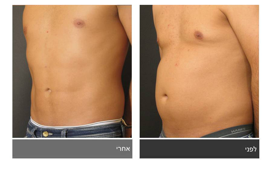 ניתוח קוביות בבטן - תמונות לפני ואחרי 5