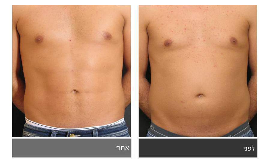 ניתוח קוביות בבטן - תמונות לפני ואחרי 6