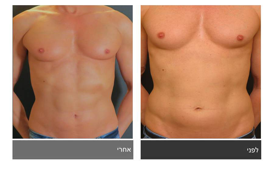 ניתוח קוביות בבטן - תמונות לפני ואחרי 28
