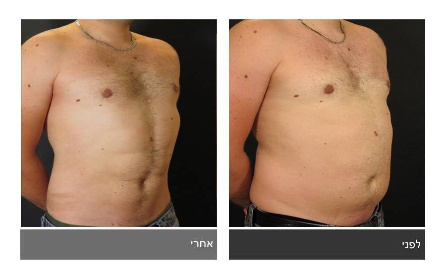 ניתוח קוביות בבטן - תמונות לפני ואחרי 29