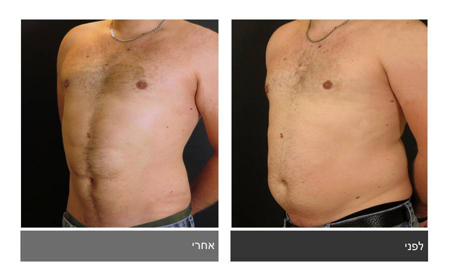 ניתוח קוביות בבטן - תמונות לפני ואחרי 30