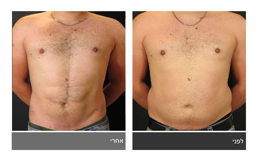ניתוח קוביות בבטן - תמונות לפני ואחרי 31