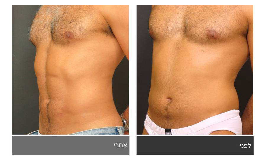 ניתוח קוביות בבטן - תמונות לפני ואחרי 25