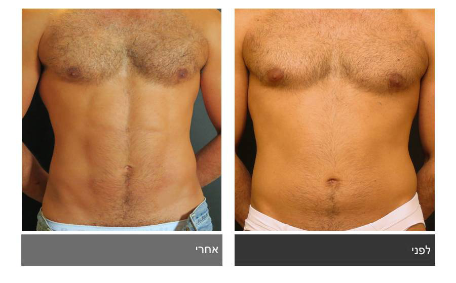 ניתוח קוביות בבטן - תמונות לפני ואחרי 26