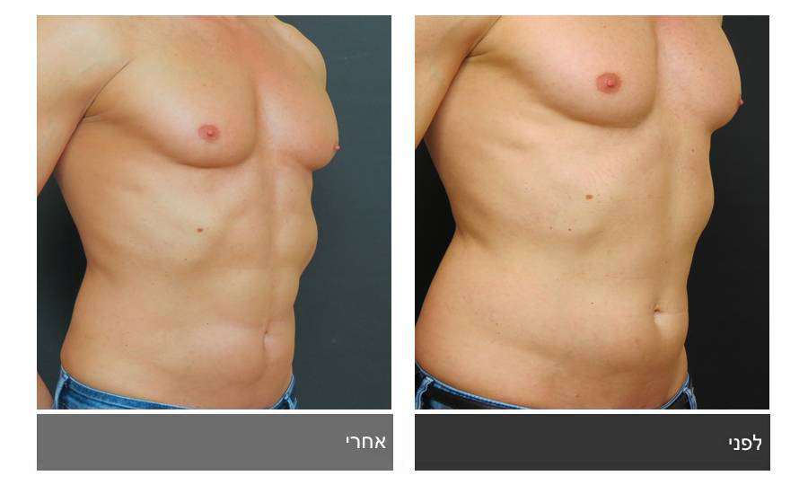 ניתוח קוביות בבטן - תמונות לפני ואחרי 32
