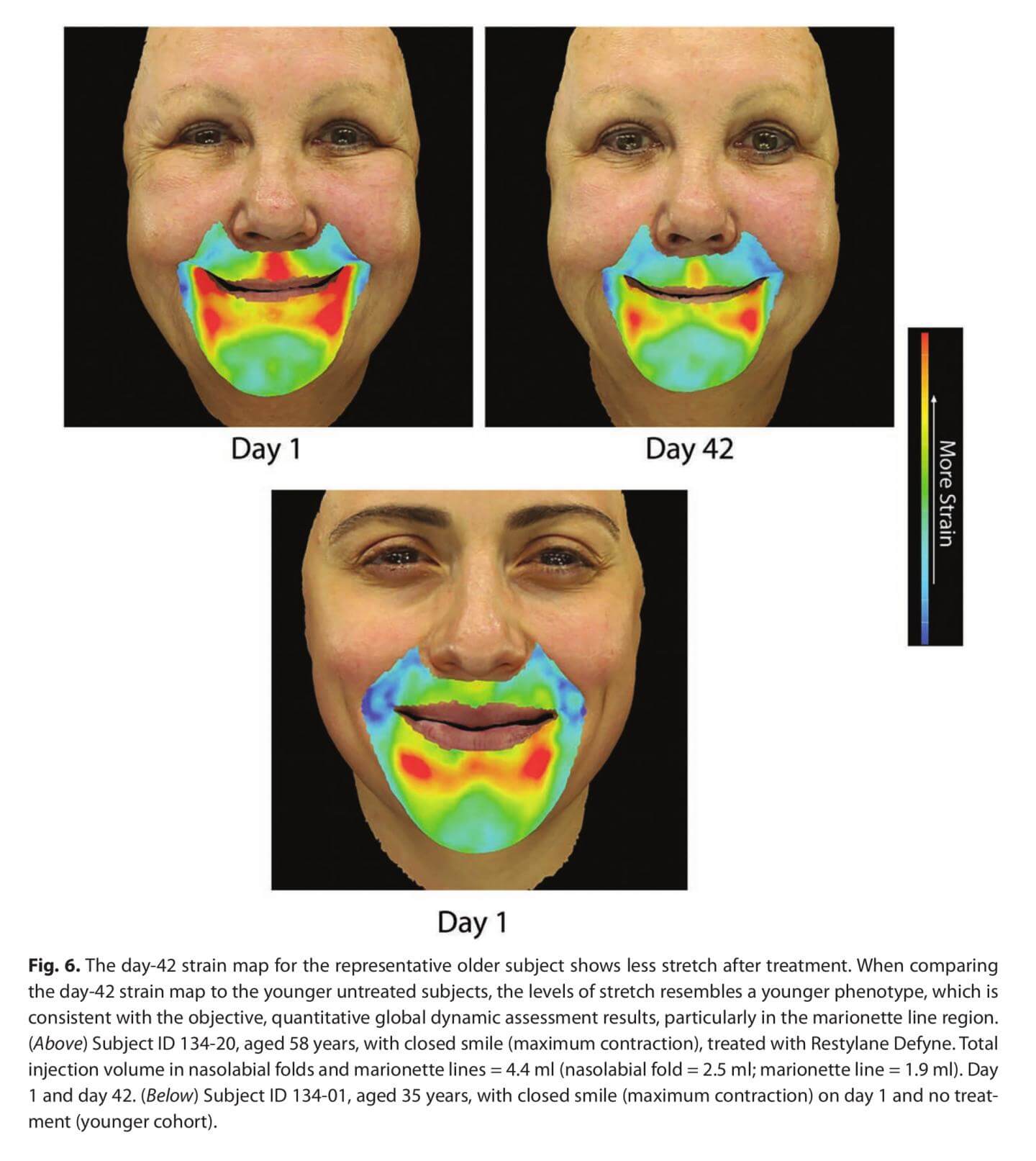 חומרי מילוי המבוססים על חומצה היאלורונית גם מחזירים דינמיקת תנועה צעירה יותר של הפנים