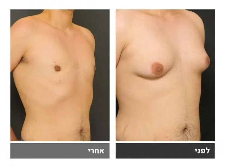 גינקומסטיה לפני ואחרי