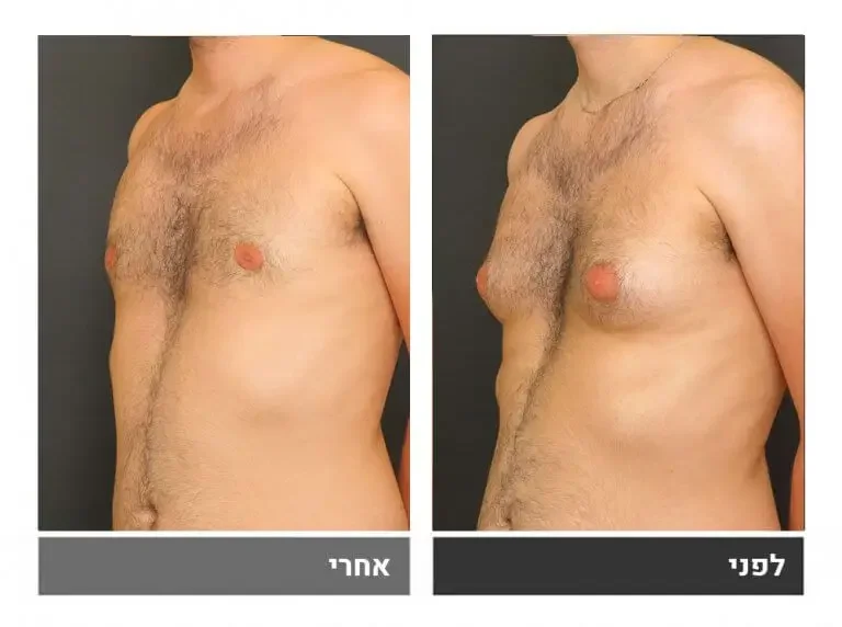 גניקומסטיה - תמונת לפני ואחרי
